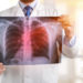 Un análisis de sangre revolucionario detectaría el cáncer de pulmón cuando aún es curable
