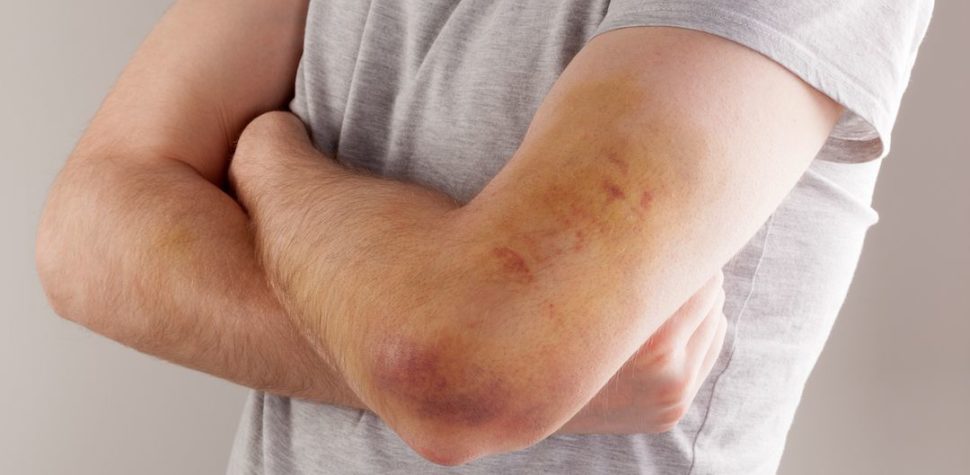 Deficiencia del factor XI